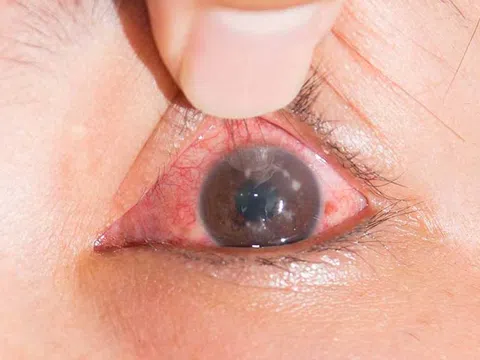 Thói quen nhiều người mắc dễ dẫn đến bệnh nguy hiểm gây mù vĩnh viễn