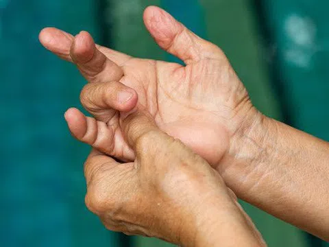 Ngón tay gấp khó duỗi, có nguy hiểm không?