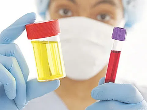 Tự 'bắt bệnh' qua màu sắc, mùi nước tiểu
