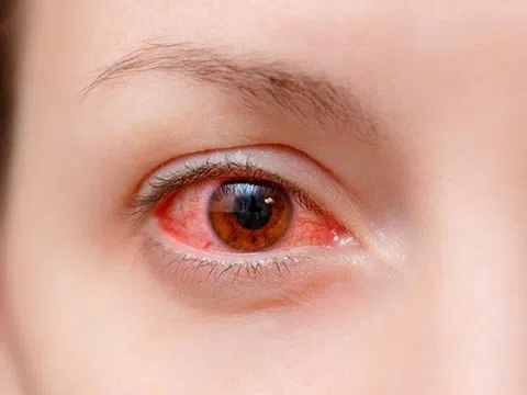 Làm gì để tránh bị đau mắt đỏ?