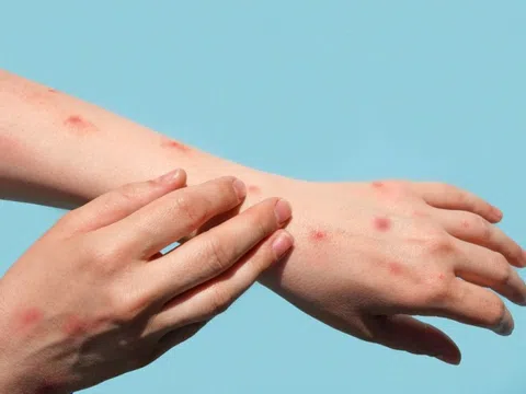 Biểu hiện và đường lây của bệnh đậu mùa khỉ