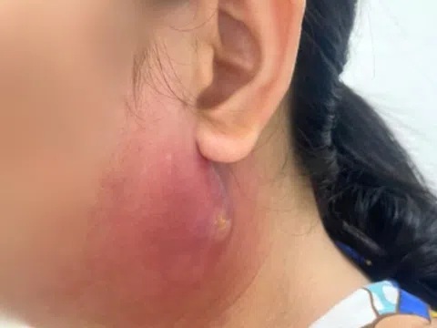 Chủ quan với mụn nhọt, tự ý điều trị tại nhà dẫn đến nguy hiểm tính mạng