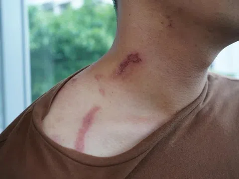 Dấu hiệu trên da chứng tỏ bị kiến ba khoang đốt