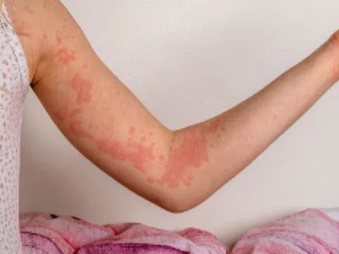 Dấu hiệu cần nhập viện khi bị dị ứng thức ăn