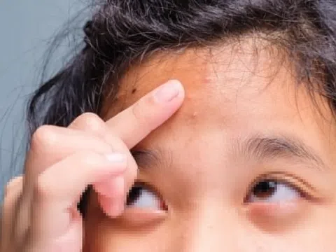 Cần làm gì khi trẻ bị mụn trứng cá?