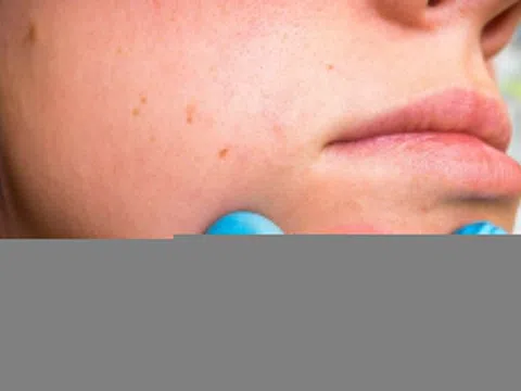 Hai cách điều trị mụn nhọt tại nhà