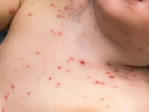 Biến chứng nguy hiểm của bệnh thủy đậu