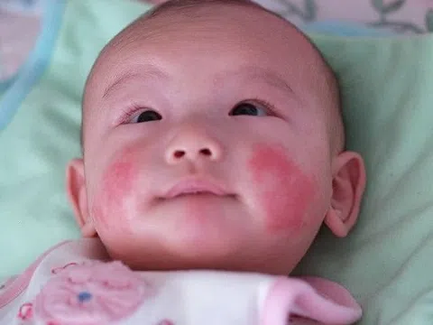 Làm sao để xóa vết bớt trên mặt trẻ?