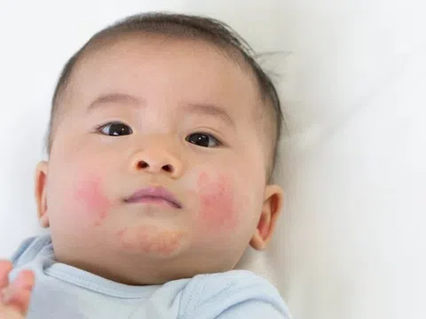 Nguyên nhân gây chàm sữa ở trẻ