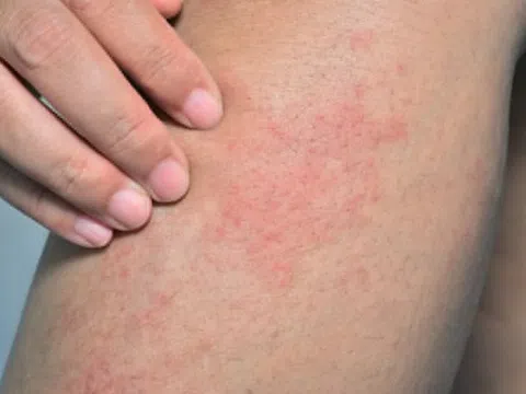 Thực phẩm phổ biến gây dị ứng