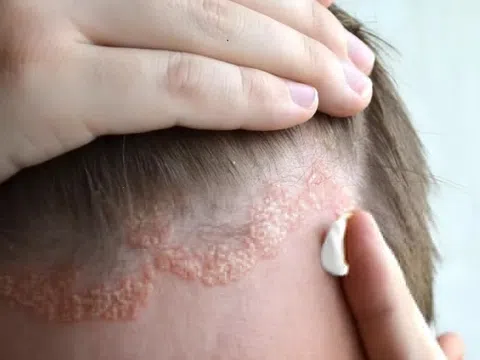 Nấm da đầu có lây không?