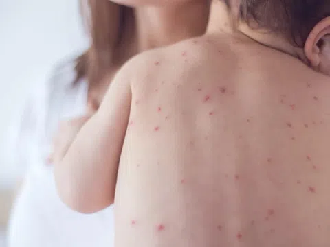 Những thực phẩm đại kỵ với người bị thủy đậu