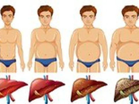 Chỉnh men gan cao theo cách tự nhiên tại nhà không dùng thuốc