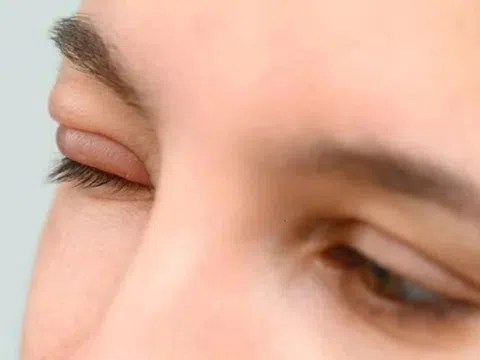 Làm gì khi mắt bị lẹo?