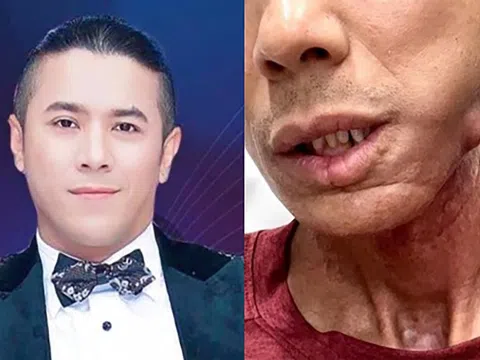 Bệnh ca sĩ Kasim Hoàng Vũ mắc có dễ gặp và nguyên nhân từ đâu?
