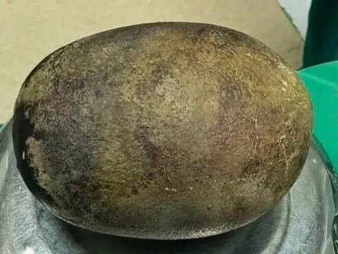 Viên sỏi nặng tới 700 gram trong cơ thể người đàn ông
