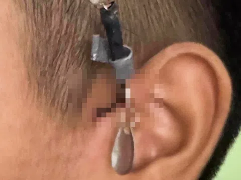 Xem câu cá, bé trai bị móc câu đâm sâu sát vùng tai