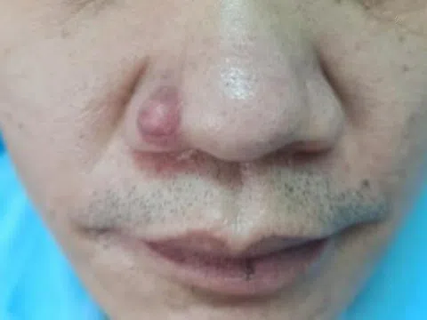 Khối u nhỏ cảnh báo bệnh ung thư hiếm gặp
