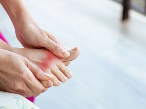 Bệnh gout có di truyền không?