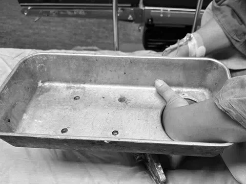 Nhập viện với bàn tay kẹt trong máy xay thịt
