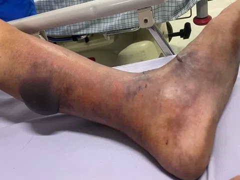 Người đàn ông nhiễm liên cầu lợn sau 5 ngày ăn tiết mua ở chợ