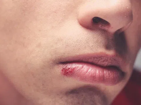 Một số bệnh lây truyền qua đường tình dục từ nụ hôn