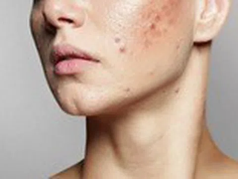 Giảm thiểu sẹo do mụn để lại bằng cách nào?
