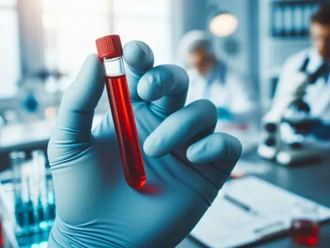 Nhóm máu có nguy cơ bị đột quỵ cao hơn