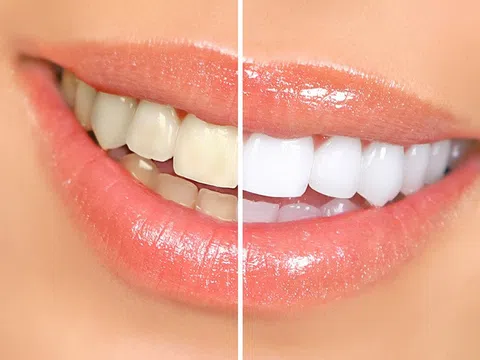 Tẩy trắng răng tại nhà cần ghi nhớ gì, bao lâu có kết quả?