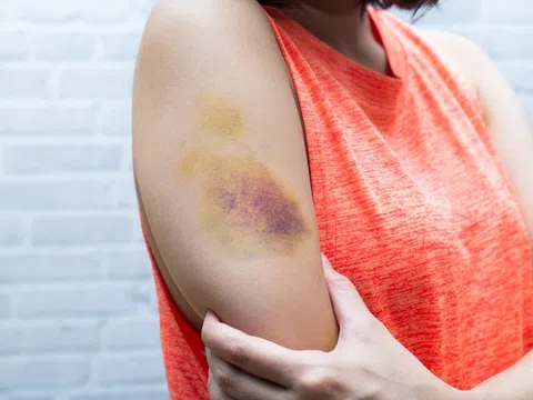 Dấu hiệu trên da cảnh báo gan đang dần mất chức năng
