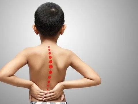 Biến chứng của cong vẹo cột sống ở trẻ em
