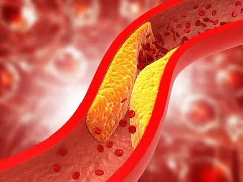 Những ai dễ bị xơ vữa động mạch?