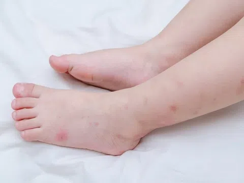 Hà Nội ghi nhận ca thứ hai mắc não mô cầu