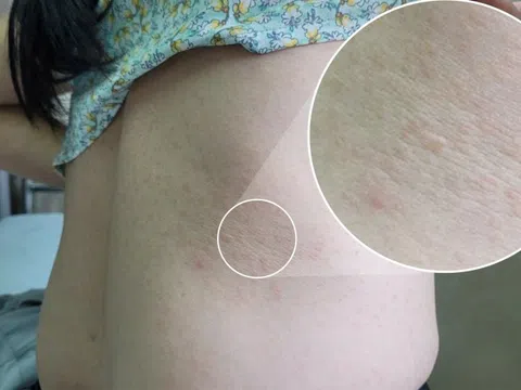Ngứa ngáy suốt 2 năm, người phụ nữ bất ngờ khi biết lý do