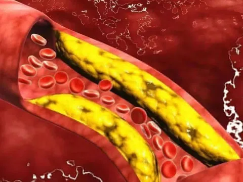 Thói quen tưởng đơn giản nhưng giảm mỡ máu hiệu quả