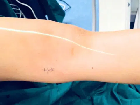 Phẫu thuật chỉnh xương gãy cho bé trai bằng phương pháp hiện đại