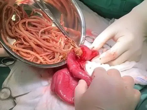 Bác sĩ bất ngờ khi gắp hơn 100 con giun trong ruột bé trai