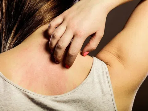 Vì sao luôn cảm thấy ngứa dù đã tắm sạch sẽ