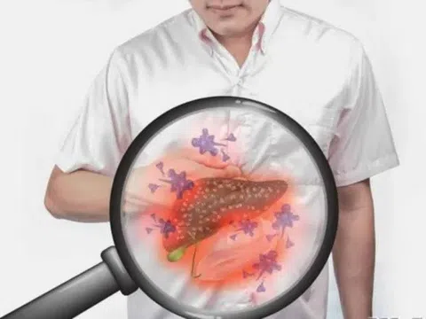 Ba 'đen' trên cơ thể cảnh báo gan đang kêu cứu
