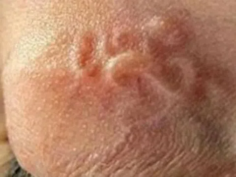 Nhiễm sán chó là gì?