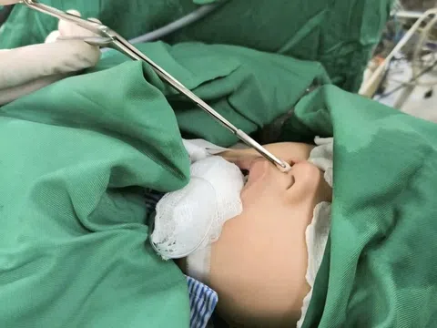 Răng mọc ở trong mũi hiếm gặp