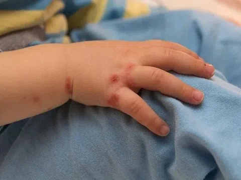 Một dấu hiệu giúp nhận biết trẻ mắc tay chân miệng trở nặng