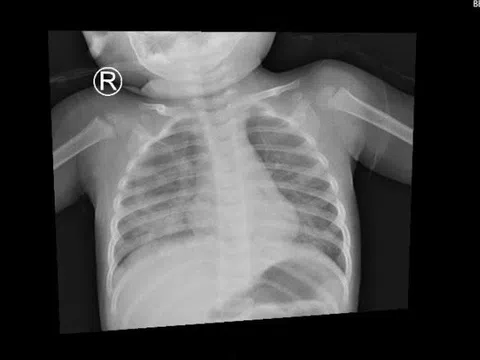 Bé trai 1 tuổi ở TP.HCM nhập viện vì hít dầu để thắp đèn
