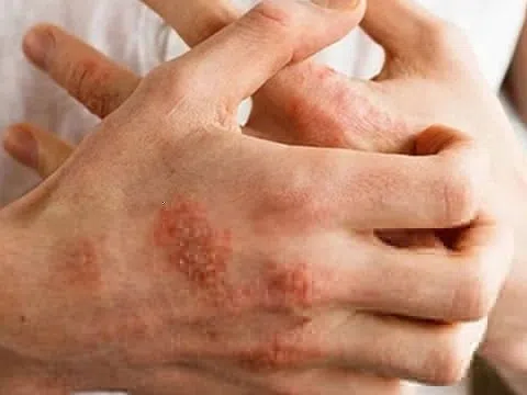 Giao mùa thận trọng với dị ứng thời tiết