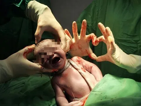 Em bé chào đời với tràng hoa quấn cổ 3 vòng