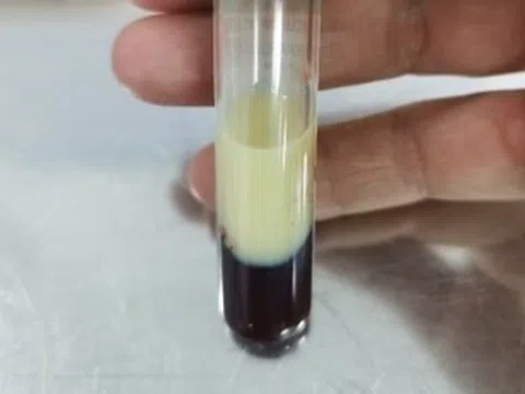 Một biến chứng nguy hiểm của mỡ máu