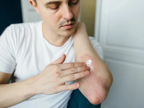 Viêm da cơ địa dùng thuốc như thế nào?