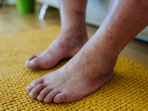 Một bệnh thường gặp ở người già đang trẻ hoá tại Việt Nam