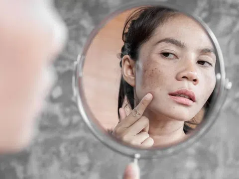 Làm thế nào để không tái nám?