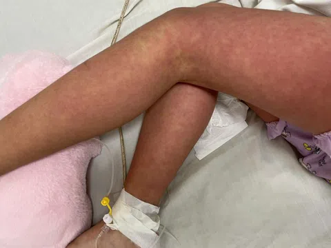 Bé gái nổi ban toàn thân, không ngờ mắc bệnh hiếm